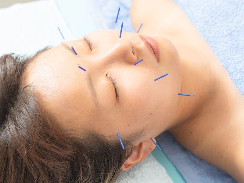 お顔に細い鍼を刺した美容鍼の様子